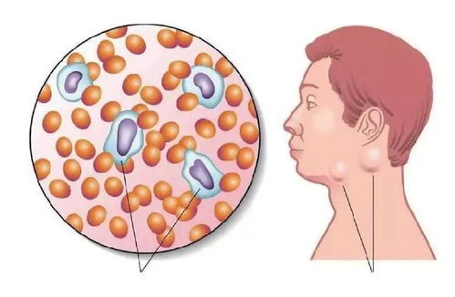 颅底肿瘤晚期症状及表现 颅底肿瘤晚期症状及表现