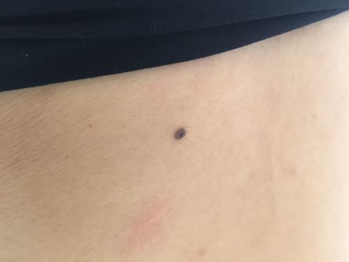 白介素2的肿瘤治疗方案 白介素2的肿瘤治疗方案