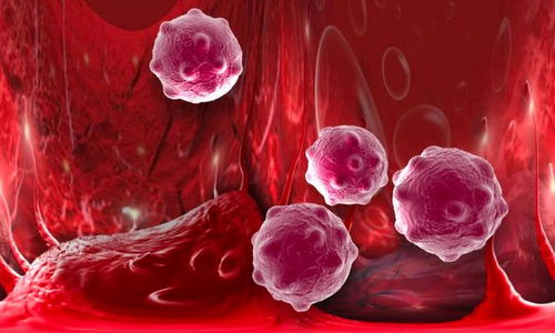 乳腺肿瘤最严重的是什么 乳腺肿瘤最严重的是什么