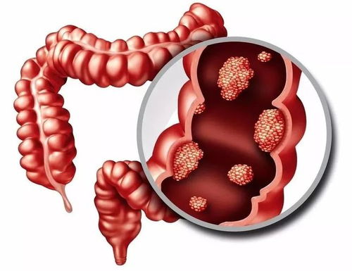 很少出现钙化的颅内肿瘤 很少出现钙化的颅内肿瘤
