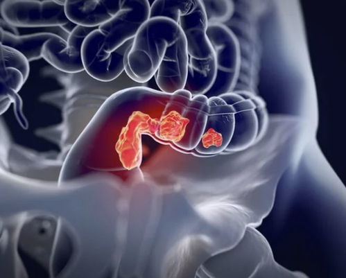 直肠肿瘤会不会影响排尿 直肠肿瘤会不会影响排尿