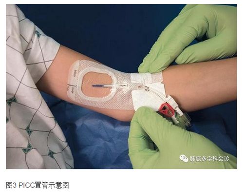 臀部的肿瘤会危及生命吗 臀部的肿瘤会危及生命吗