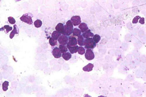 年轻人脸部肿瘤怎么办 年轻人脸部肿瘤怎么办