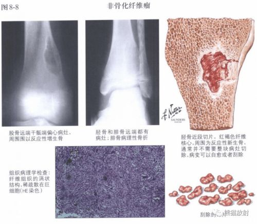 肠胃肿瘤的信号有哪些 肠胃肿瘤的信号有哪些