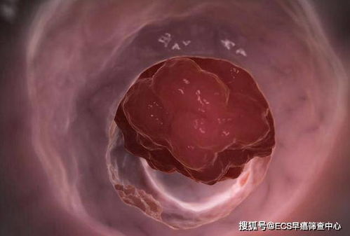 超声治疗肿瘤 超声治疗癌的方法 超声治疗肿瘤 超声治疗癌的方法