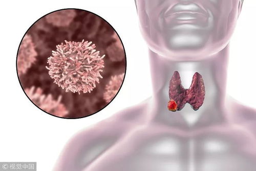 感冒会影响肿瘤筛查吗 感冒会影响肿瘤筛查吗