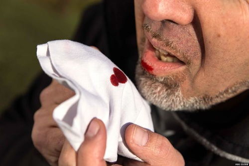 肝2.6cm肿瘤肝肿瘤2.7cm2.8cm的肿瘤大吗 肝2.6cm肿瘤肝肿瘤2.7cm2.8cm的肿瘤大吗