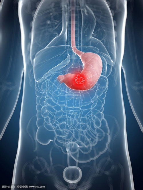 左肾肿瘤有啥症状表现 左肾肿瘤有啥症状表现