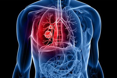 牛淋巴肿瘤 牛淋巴结 牛淋巴肿瘤 牛淋巴结