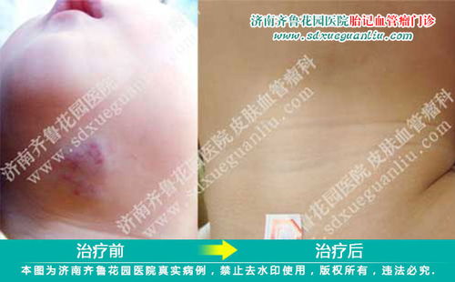 扁桃体肿瘤有什么症状 扁桃体肿瘤有什么症状