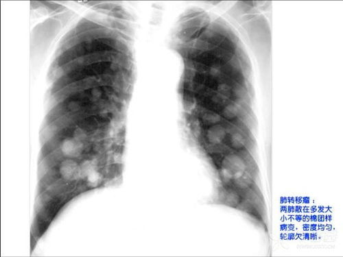肿瘤医院咨询在线哈尔滨 肿瘤医院咨询在线哈尔滨