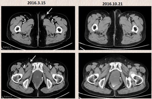 脑子里有五十毫米肿瘤 脑子里有五十毫米肿瘤