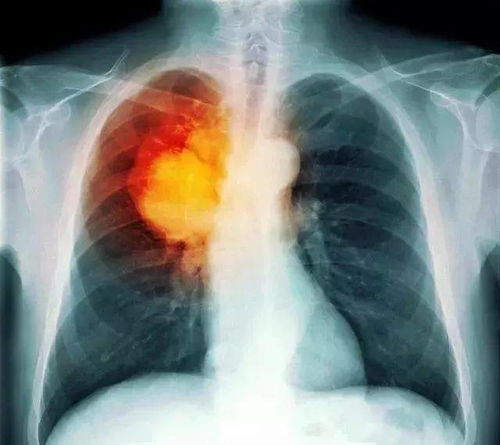 左肾偏强回声是肿瘤吗 左肾偏强回声是肿瘤吗