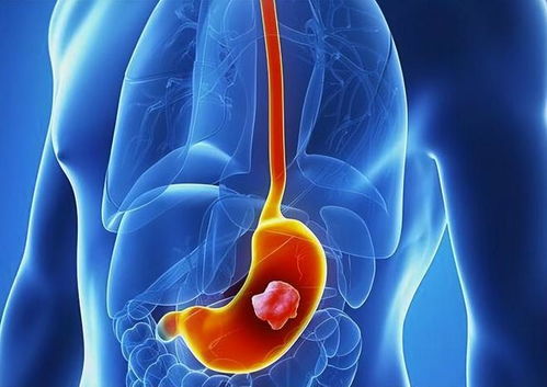 身体哪一种炎症会长肿瘤 身体哪一种炎症会长肿瘤