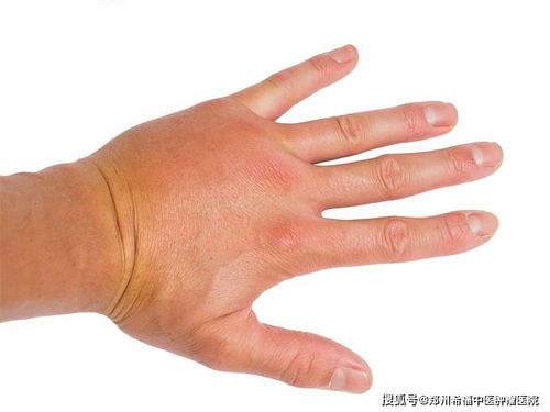 鼻咽部肿瘤会有血痰吗 鼻咽部肿瘤会有血痰吗