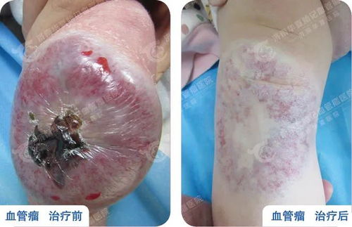 脑部恶性肿瘤的诱因是 脑部恶性肿瘤的诱因是