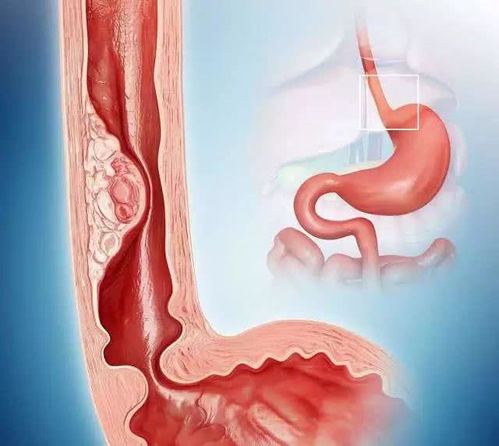 淋巴肿瘤会传染家人吗 淋巴肿瘤会传染家人吗