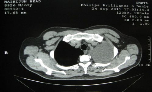 为啥肿瘤不能吃糖果 为啥肿瘤不能吃糖果呢 为啥肿瘤不能吃糖果 为啥肿瘤不能吃糖果呢