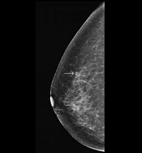 胃肿瘤化疗后要吃韭菜吗 胃肿瘤化疗后要吃韭菜吗