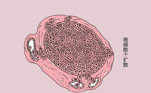胃口和食管连接处长肿瘤 胃口和食管连接处长肿瘤