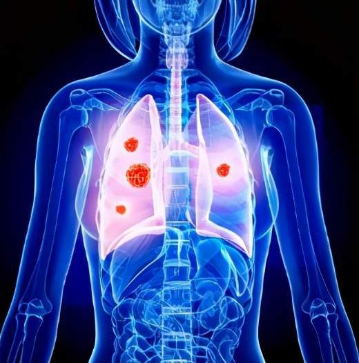 上颌窦恶性肿瘤生存时间 上颌窦恶性肿瘤生存时间