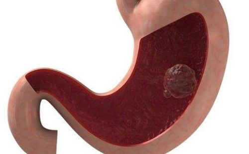 恶性肿瘤长的像什么动物 恶性肿瘤长的像什么动物