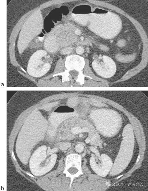 胸腺肿瘤手术复发率高吗 胸腺肿瘤手术复发率高吗