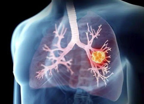 膀胱肿瘤可以活30年吗 膀胱肿瘤可以活30年吗