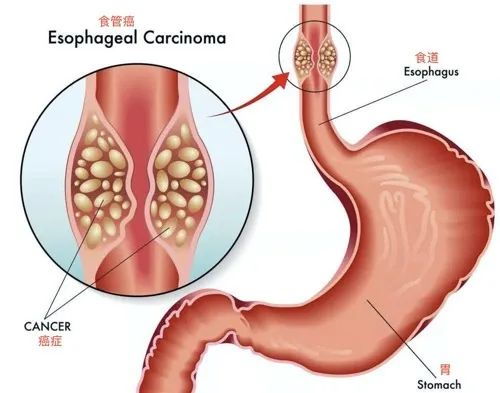 腱鞘囊肿是肿瘤吗腱鞘囊肿是肿瘤吗严重吗 腱鞘囊肿是肿瘤吗腱鞘囊肿是肿瘤吗严重吗