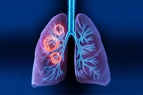 切除结肠肿瘤后高烧不退 切除结肠肿瘤后高烧不退
