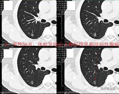 头晕引起的肿瘤有哪些 头晕引起的肿瘤有哪些