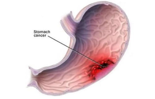 乳腺结节4级肿瘤怎么治 乳腺结节4级肿瘤怎么治