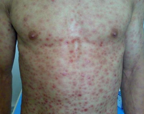 女性肿瘤全套包含几项 女性肿瘤全套包含几项