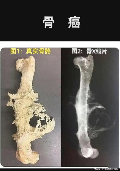 肿瘤不能吃三样东西吗 肿瘤不能吃三样东西吗