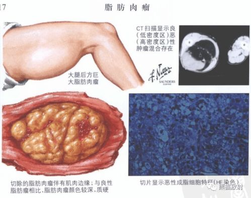 肩胛骨疼痛肿瘤症状(肩胛骨肿瘤有什么症状) 肩胛骨疼痛肿瘤症状(肩胛骨肿瘤有什么症状)