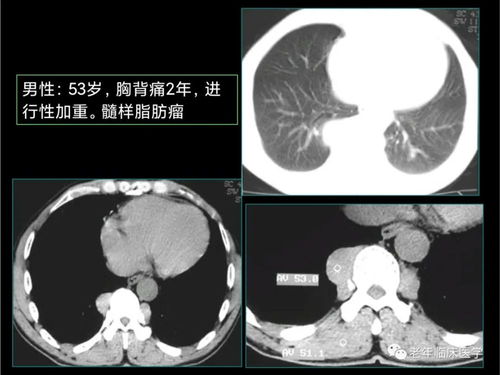 什么叫耳朵肿瘤病理 耳科肿瘤 什么叫耳朵肿瘤病理 耳科肿瘤