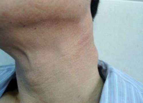 脑部结节转化肿瘤的症状 脑部结节转化肿瘤的症状