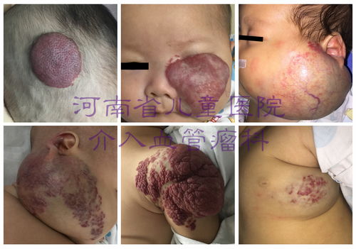 昆布抗肿瘤用量 昆布药理 昆布抗肿瘤用量 昆布药理