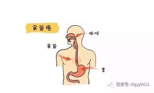 卵巢肿瘤去哪个医院好些 卵巢肿瘤去哪个医院好些