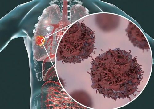 食道口肿瘤手术怎么做 食道口肿瘤手术怎么做