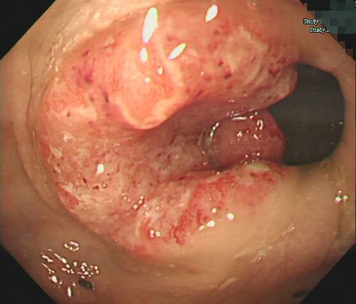 ������ɱ�����ɺȿ����ܻ���������֢��