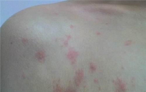 肋软骨恶性肿瘤有肿块吗 肋软骨恶性肿瘤有肿块吗