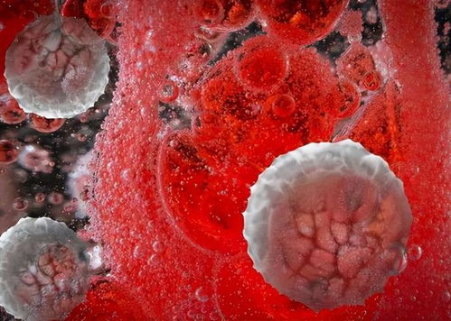 肺部炎性增殖灶是肿瘤吗 肺部炎性增殖灶是肿瘤吗