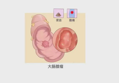 见成片肿瘤细胞核大异型 见成片肿瘤细胞核大异型