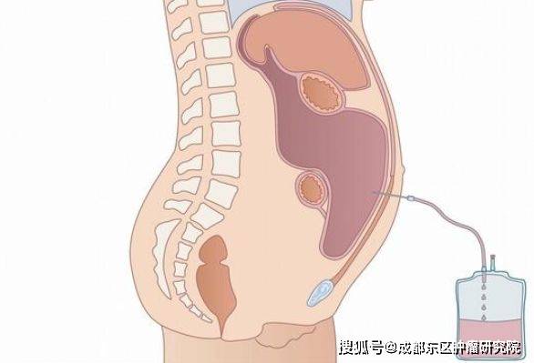 输尿管肿瘤不治会怎样呢 输尿管肿瘤不治会怎样呢