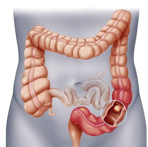 哺乳期锁骨下面有肿瘤 哺乳期锁骨下面有肿瘤