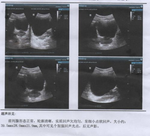 肺和食道肿瘤吃什么中药 肺和食道肿瘤吃什么中药