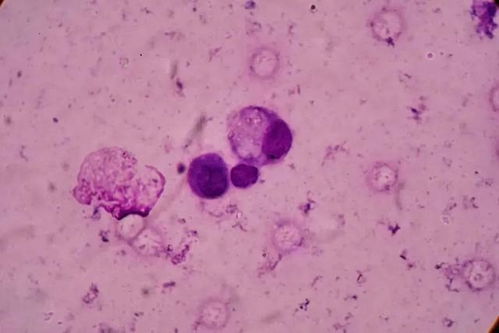 舌恶性肿瘤可以吃红薯吗 舌恶性肿瘤可以吃红薯吗