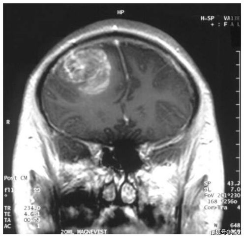 脑肿瘤会转移到肠胃吗 脑肿瘤会转移到肠胃吗