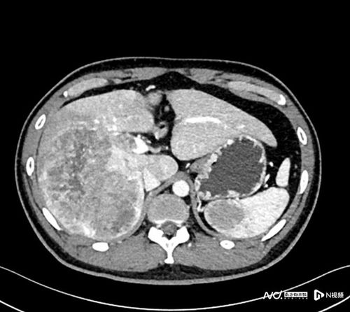 胃癌肿瘤吃什么食物好 胃癌肿瘤吃什么食物好